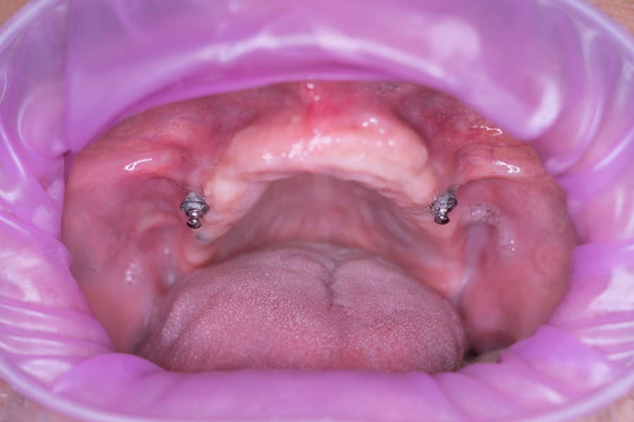 Εμφυτεύματα