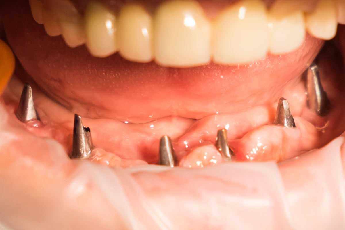 Ακίνητες αποκαταστάσεις εμφυτευμάτων