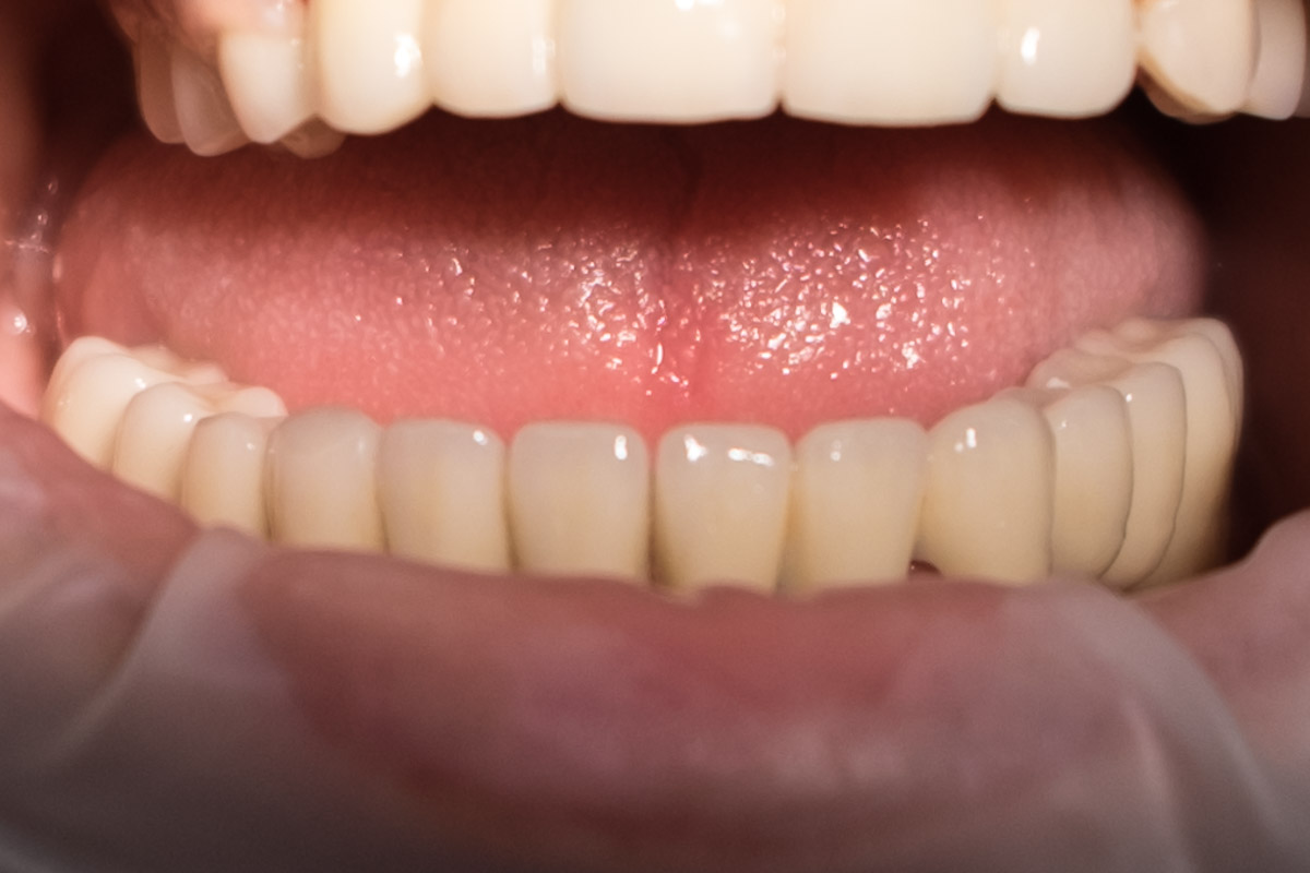 Ακίνητες αποκαταστάσεις εμφυτευμάτων