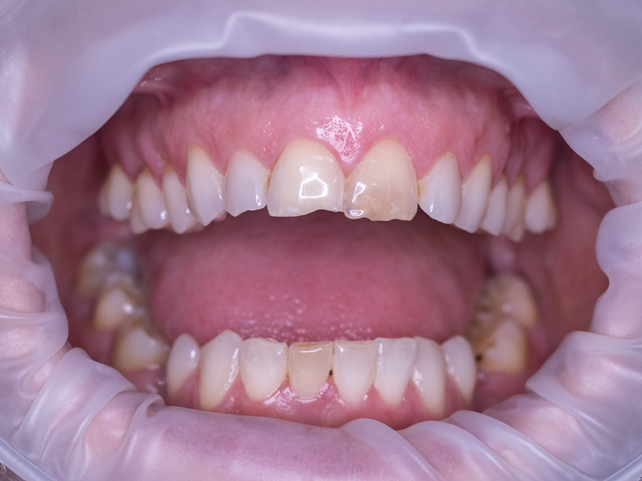 Ολοκεραμικές στεφάνες, ΑΠΟΚΑΤΑΣΤΑΣΗ ΤΩΝ ΚΑΤΕΣΤΡΑΜΕΝΩΝ ΔΟΝΤΙΩΝ