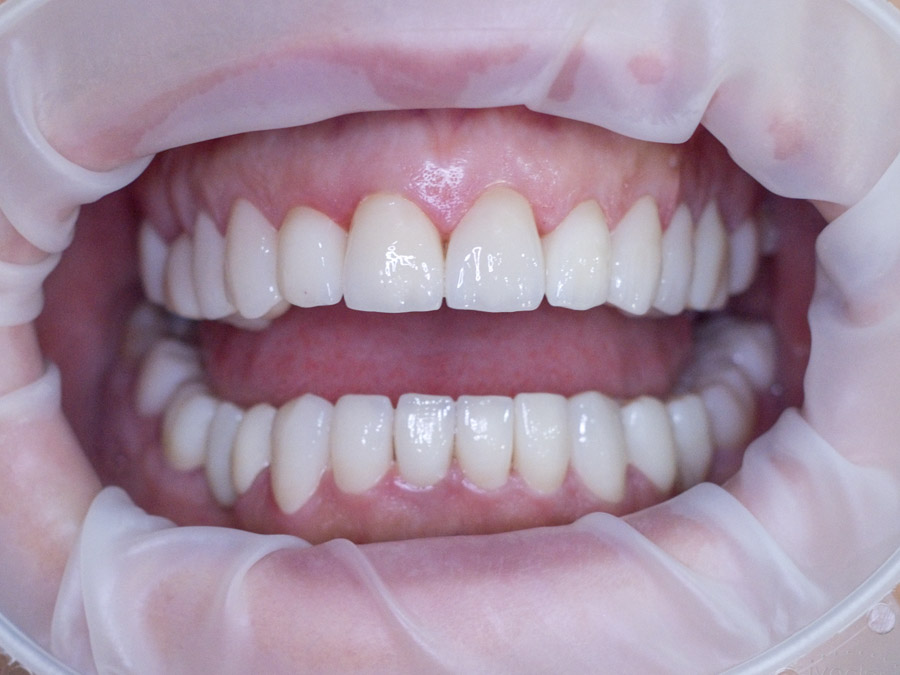 Ολοκεραμικές στεφάνες, ΑΠΟΚΑΤΑΣΤΑΣΗ ΤΩΝ ΚΑΤΕΣΤΡΑΜΕΝΩΝ ΔΟΝΤΙΩΝ