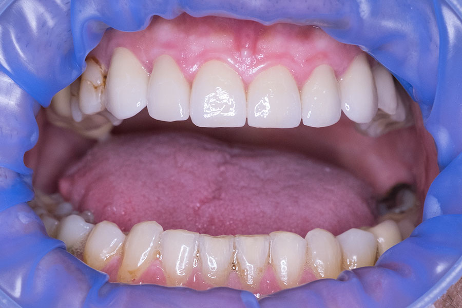 Ολοκεραμικές στεφάνες, ΑΠΟΚΑΤΑΣΤΑΣΗ ΤΩΝ ΚΑΤΕΣΤΡΑΜΕΝΩΝ ΔΟΝΤΙΩΝ