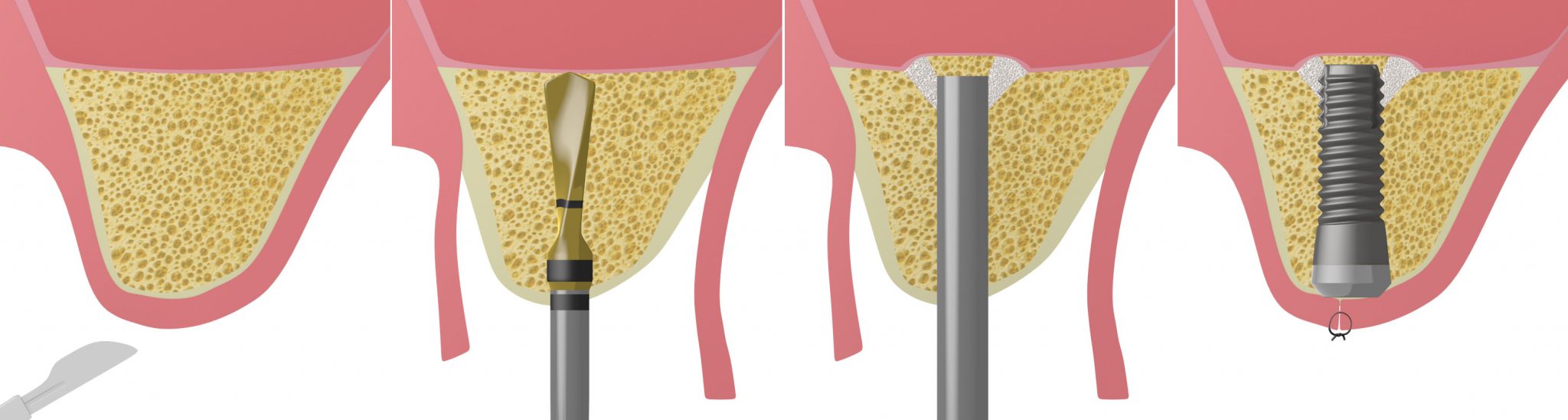 Ανύψωση Ιγμορείου