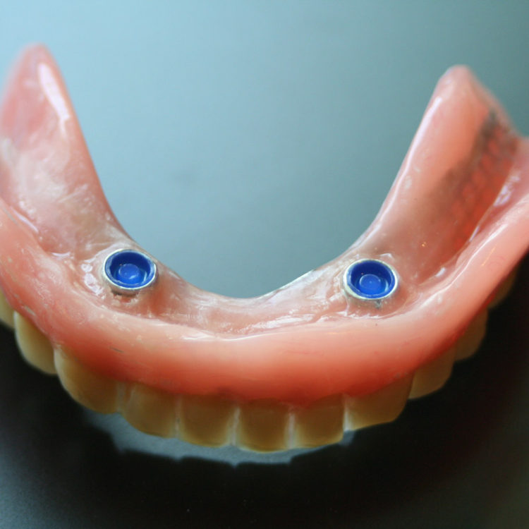 Αποκαταστάσεις εμφυτευμάτων