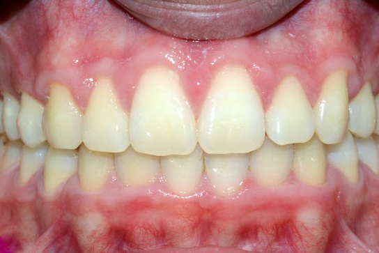 Αποκάλυψη μύλης με λέιζερ