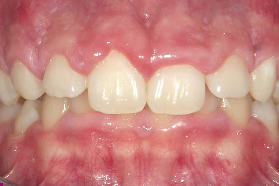 Αποκάλυψη μύλης με λέιζερ