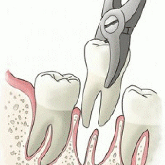Εξαγωγή Δοντιού