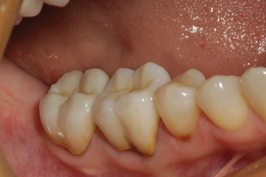 Μεταλοκεραμικές Στεφάνες