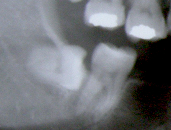 fronimitis