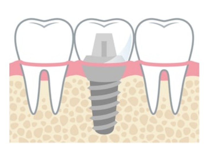 Εμφύτευμα δοντιών