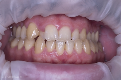 ορθοδοντική θεραπεία με νάρθηκες